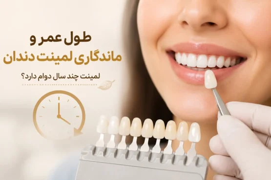 طول عمر لمینت دندان چقدر است