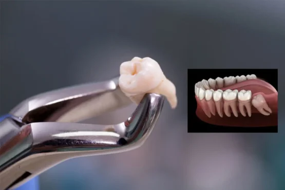 wisdom tooth extraction مراقبت های بعد از کشیدن دندان عقل